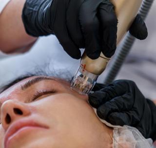 Высокочастотный микроигольчатый RF лифтинг SYLFIRM X в Ростове-на-Дону